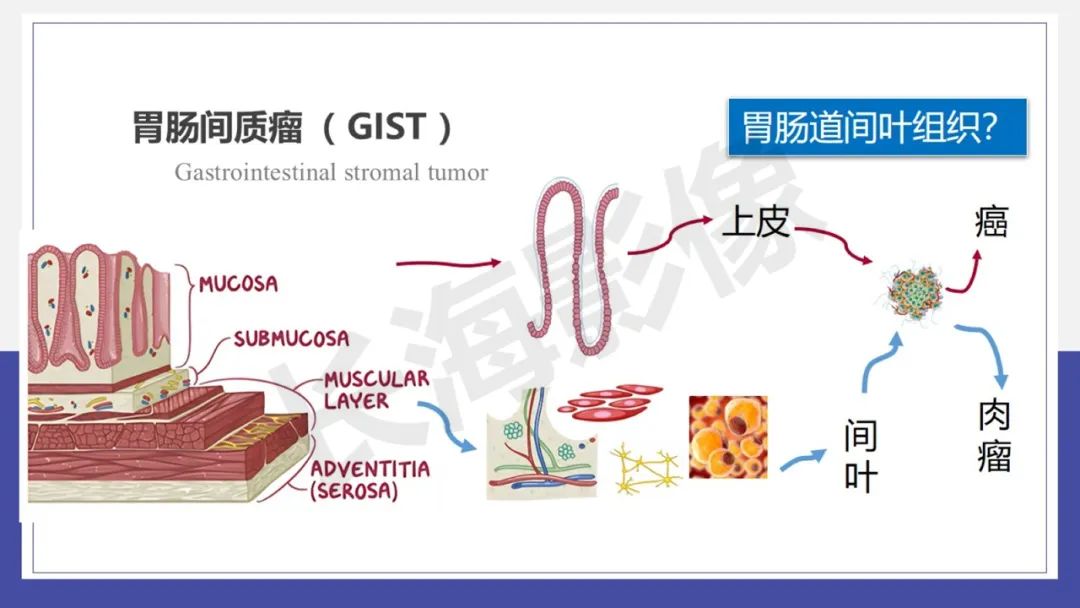 影像PPT - 【PPT 】胃肠间质瘤-5