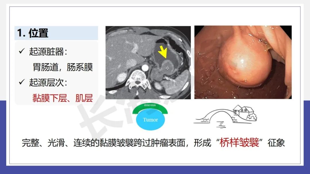 影像PPT - 【PPT 】胃肠间质瘤-9