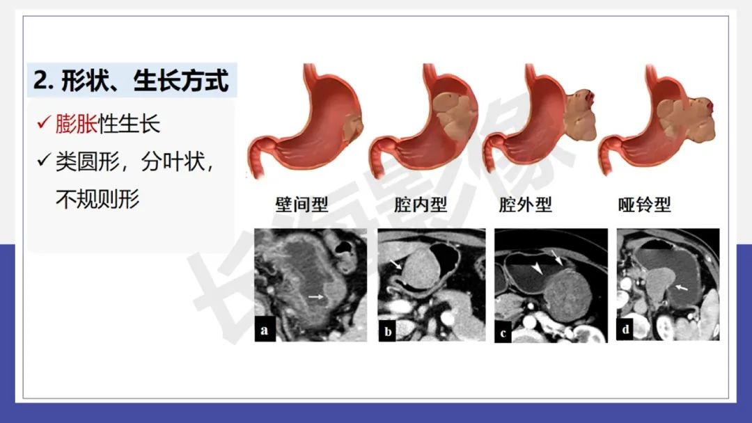 影像PPT - 【PPT 】胃肠间质瘤-10