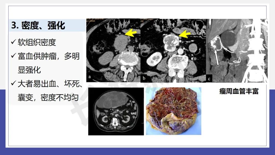 影像PPT - 【PPT 】胃肠间质瘤-11