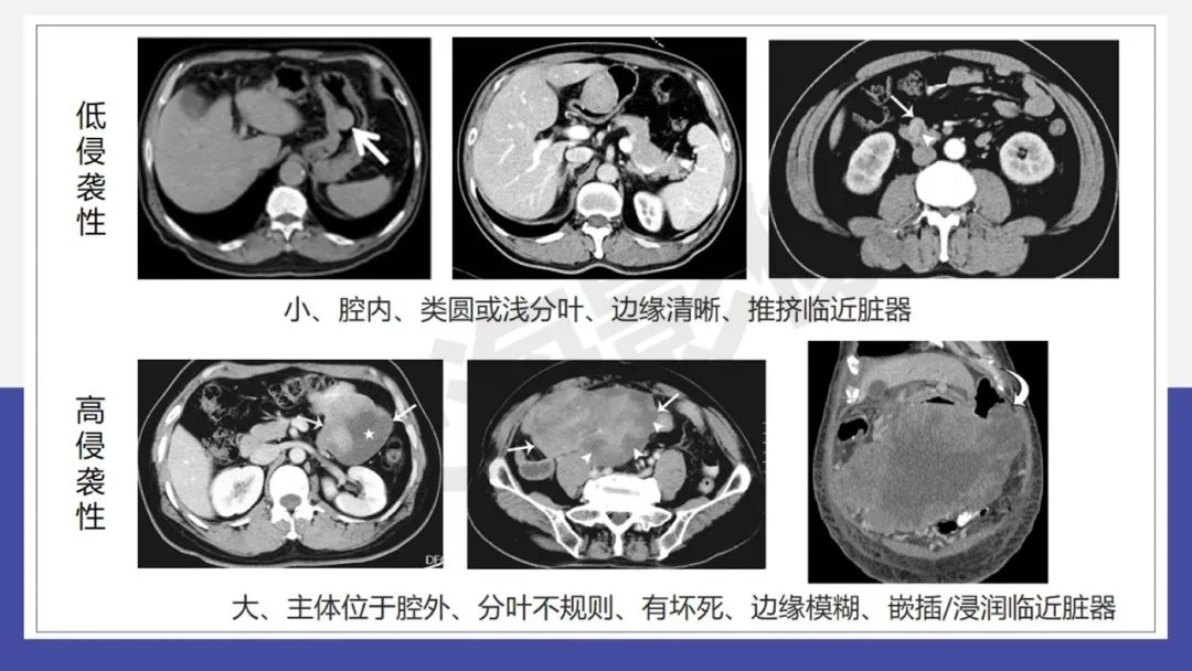 影像PPT - 【PPT 】胃肠间质瘤-14