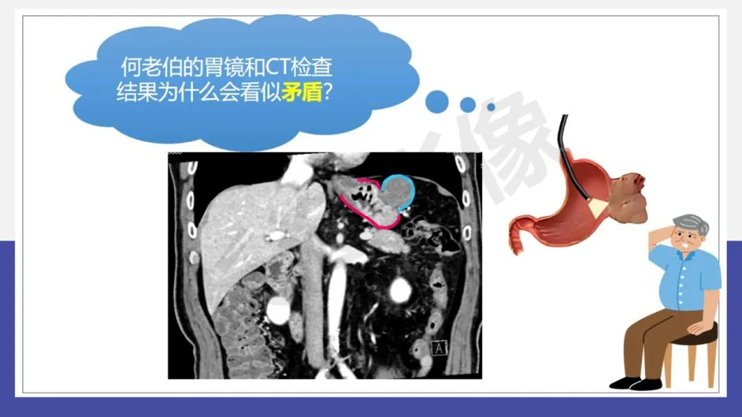 影像PPT - 【PPT 】胃肠间质瘤-18