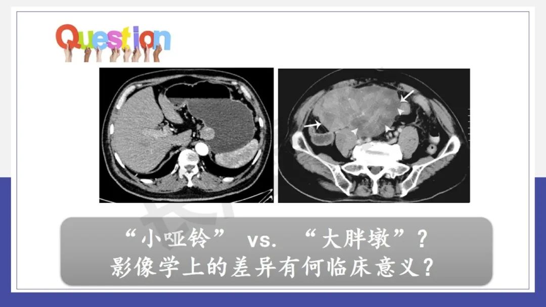 影像PPT - 【PPT 】胃肠间质瘤-12