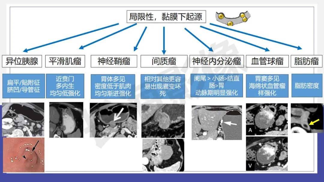 影像PPT - 【PPT 】胃肠间质瘤-19