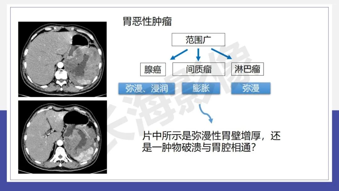 影像PPT - 【PPT 】胃肠间质瘤-21