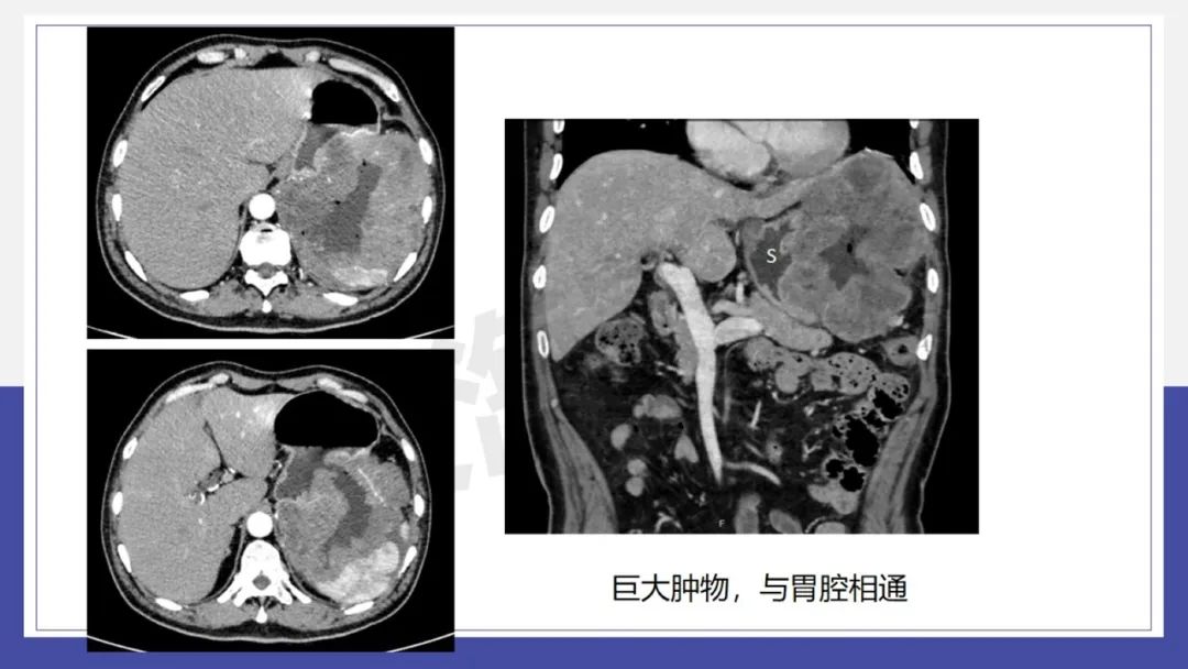 影像PPT - 【PPT 】胃肠间质瘤-22