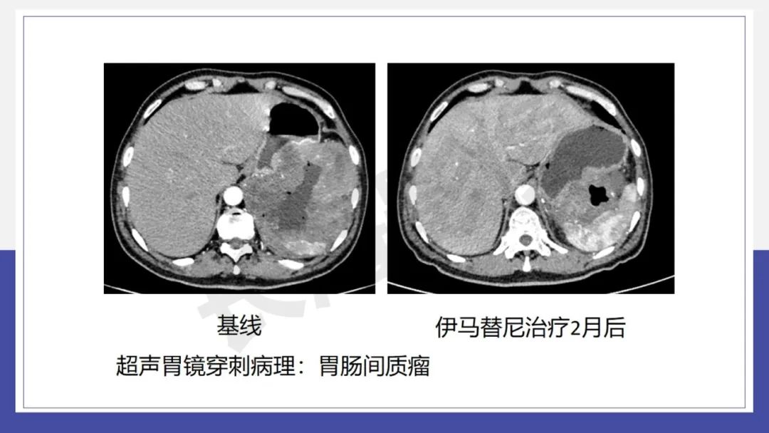 影像PPT - 【PPT 】胃肠间质瘤-23