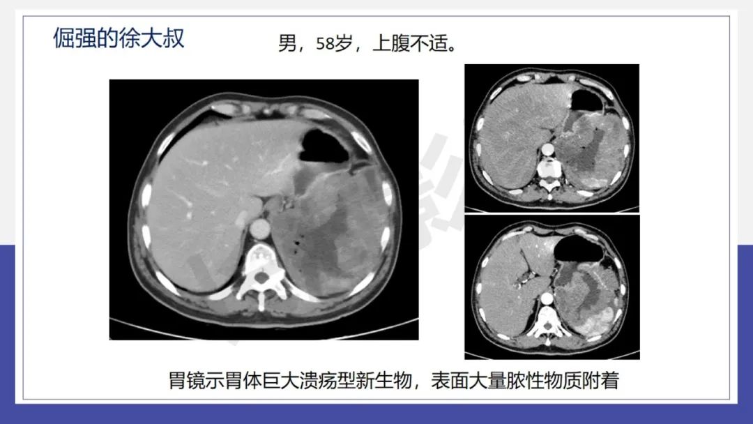 影像PPT - 【PPT 】胃肠间质瘤-20
