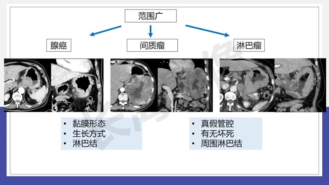 影像PPT - 【PPT 】胃肠间质瘤-24