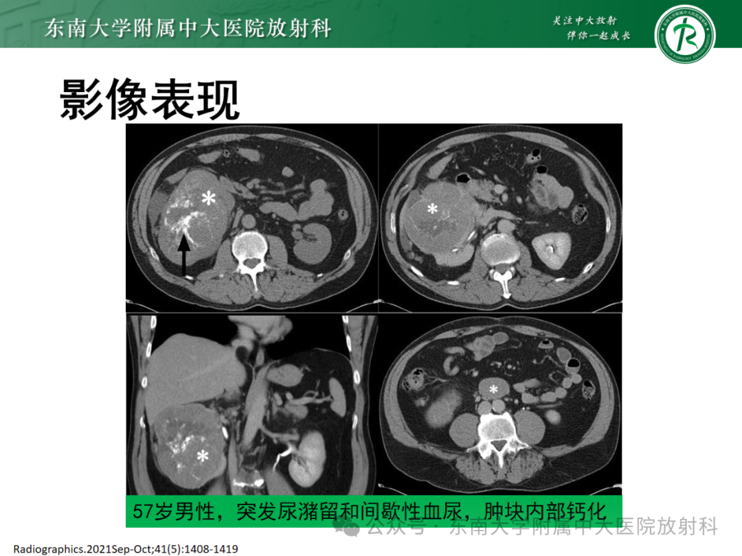 影像PPT - 【PPT】肾嫌色细胞癌-1 影像PPT - 【PPT】肾嫌色细胞癌-1