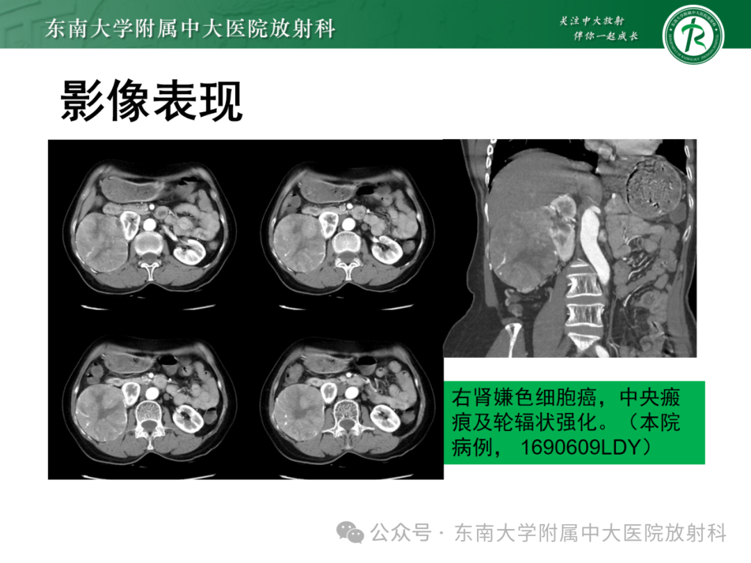 影像PPT - 【PPT】肾嫌色细胞癌-3 影像PPT - 【PPT】肾嫌色细胞癌-3