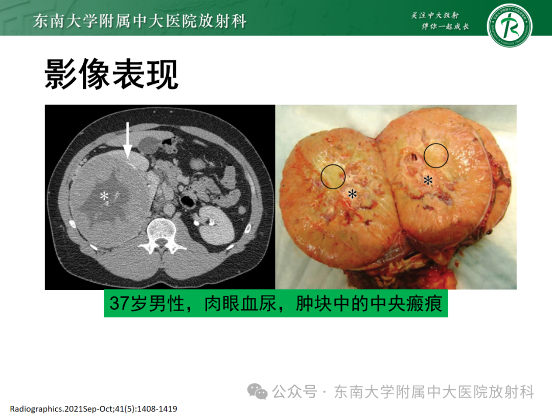 影像PPT - 【PPT】肾嫌色细胞癌-2 影像PPT - 【PPT】肾嫌色细胞癌-2