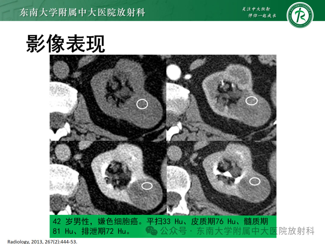 影像PPT - 【PPT】肾嫌色细胞癌-4 影像PPT - 【PPT】肾嫌色细胞癌-4