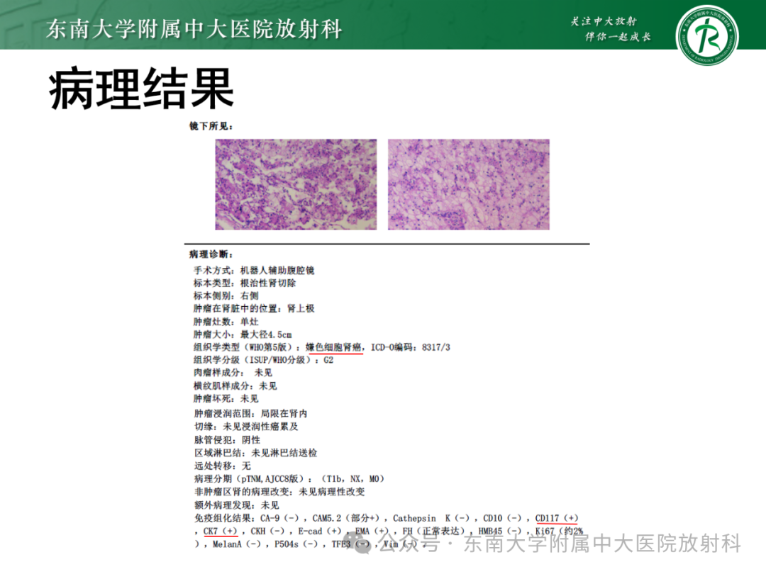 影像PPT - 【PPT】肾嫌色细胞癌-7 影像PPT - 【PPT】肾嫌色细胞癌-7