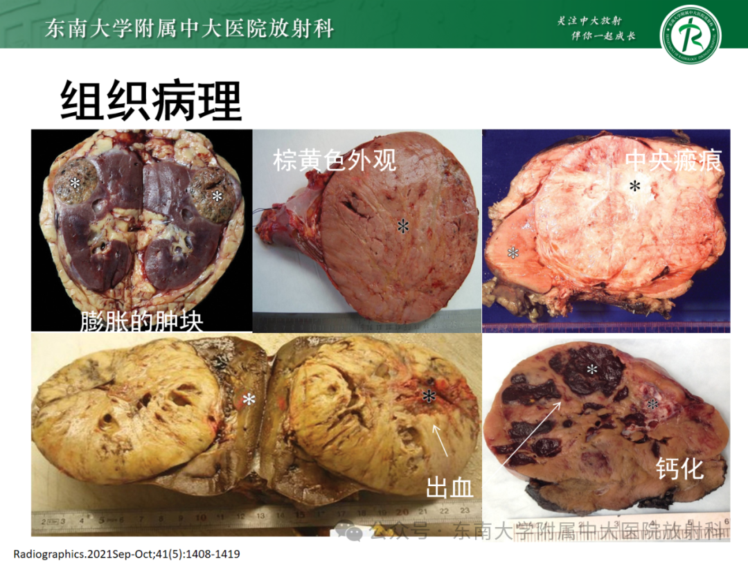 影像PPT - 【PPT】肾嫌色细胞癌-14 影像PPT - 【PPT】肾嫌色细胞癌-14