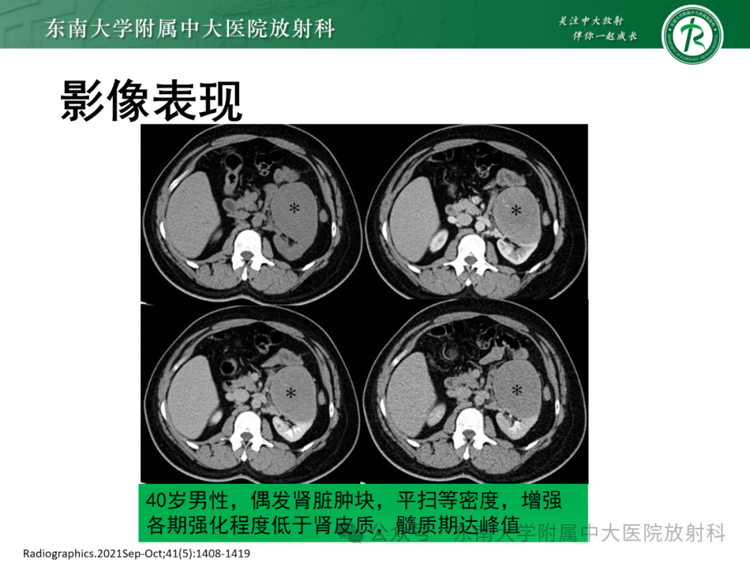 影像PPT - 【PPT】肾嫌色细胞癌-18 影像PPT - 【PPT】肾嫌色细胞癌-18