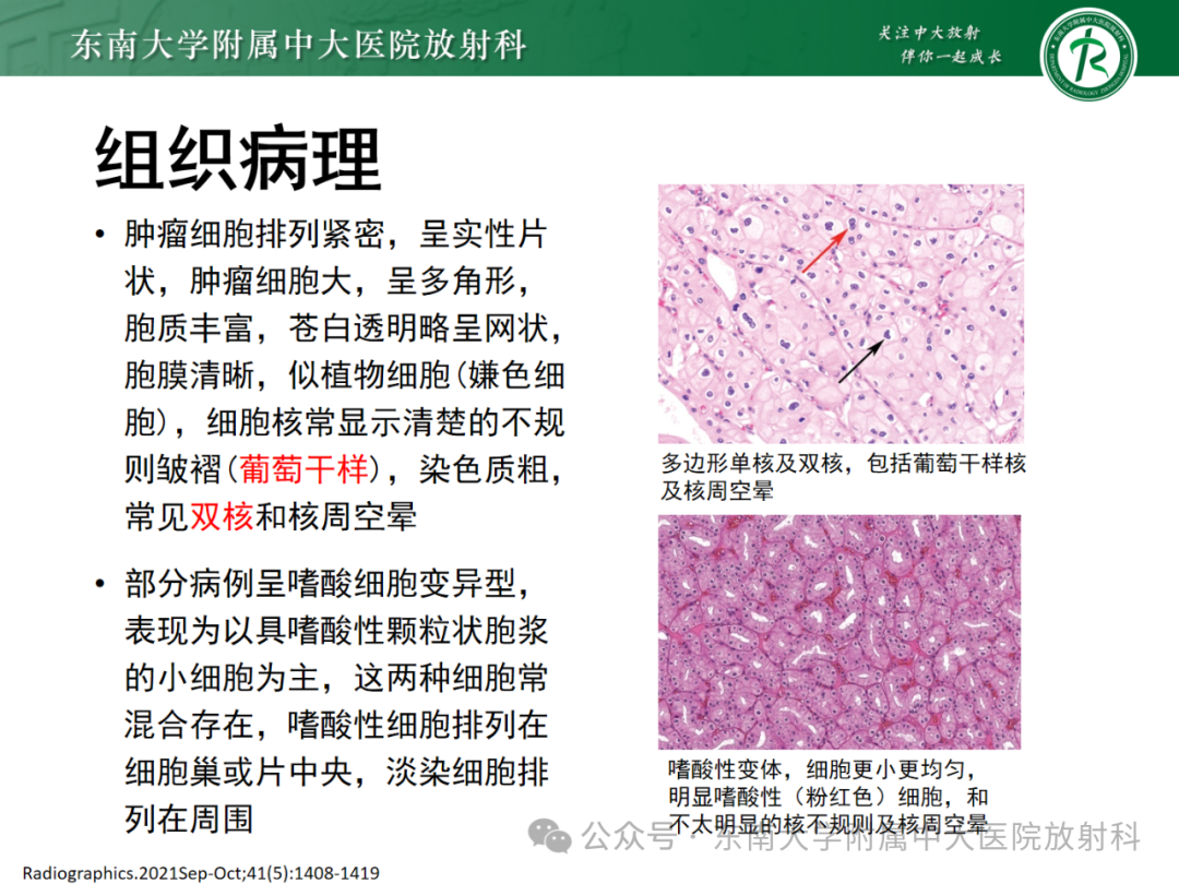 影像PPT - 【PPT】肾嫌色细胞癌-15 影像PPT - 【PPT】肾嫌色细胞癌-15