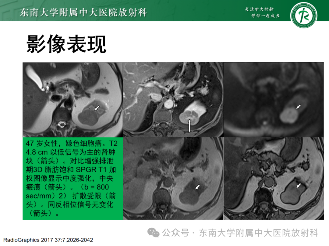 影像PPT - 【PPT】肾嫌色细胞癌-19 影像PPT - 【PPT】肾嫌色细胞癌-19