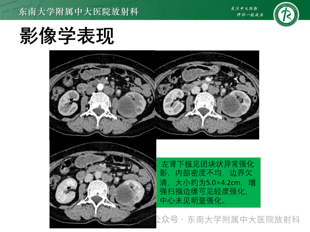 影像PPT - 【PPT】肾嫌色细胞癌-21 影像PPT - 【PPT】肾嫌色细胞癌-21