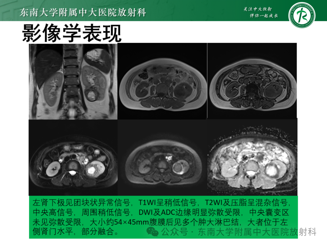影像PPT - 【PPT】肾嫌色细胞癌-22 影像PPT - 【PPT】肾嫌色细胞癌-22