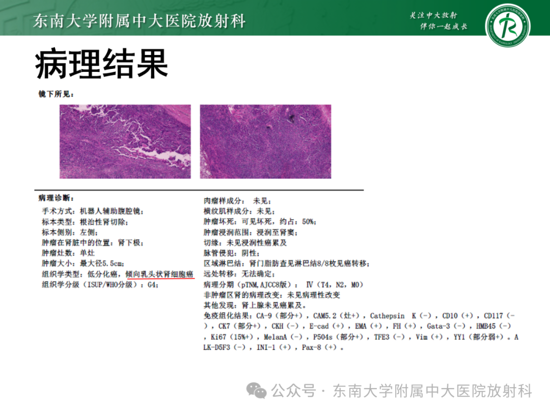 影像PPT - 【PPT】肾嫌色细胞癌-23 影像PPT - 【PPT】肾嫌色细胞癌-23