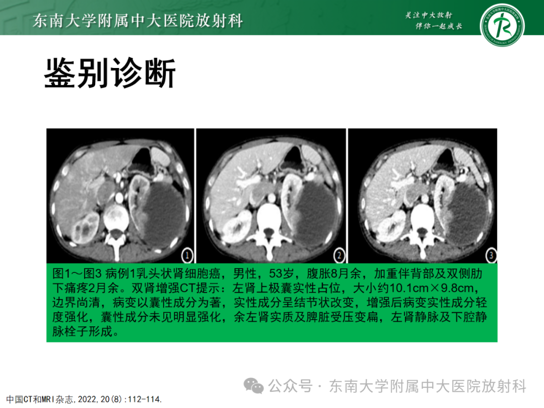 影像PPT - 【PPT】肾嫌色细胞癌-26 影像PPT - 【PPT】肾嫌色细胞癌-26