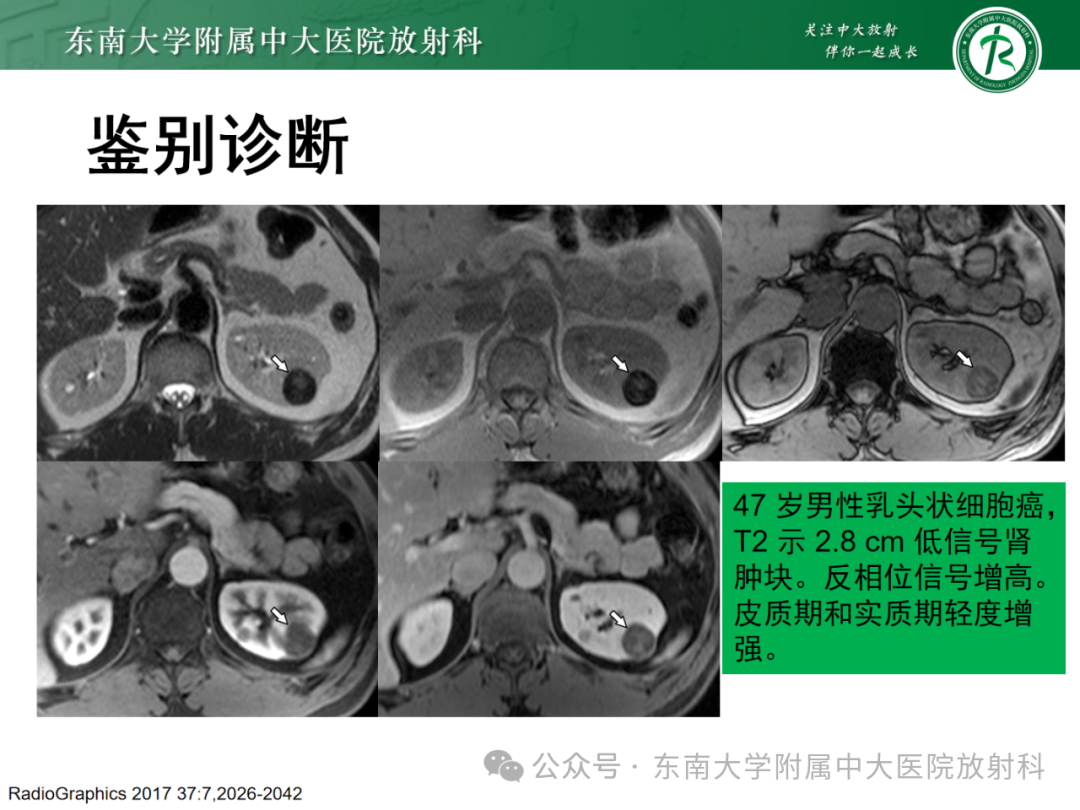 影像PPT - 【PPT】肾嫌色细胞癌-25 影像PPT - 【PPT】肾嫌色细胞癌-25