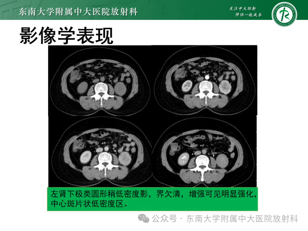 影像PPT - 【PPT】肾嫌色细胞癌-28 影像PPT - 【PPT】肾嫌色细胞癌-28