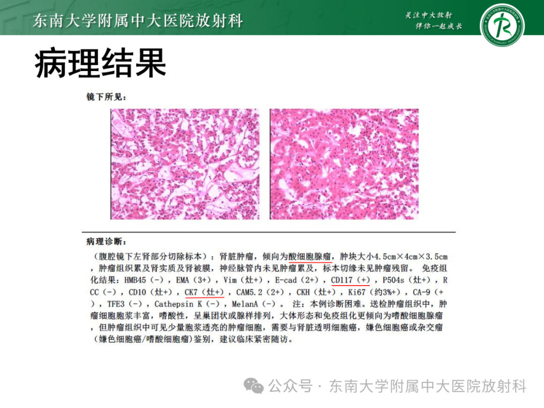 影像PPT - 【PPT】肾嫌色细胞癌-29 影像PPT - 【PPT】肾嫌色细胞癌-29