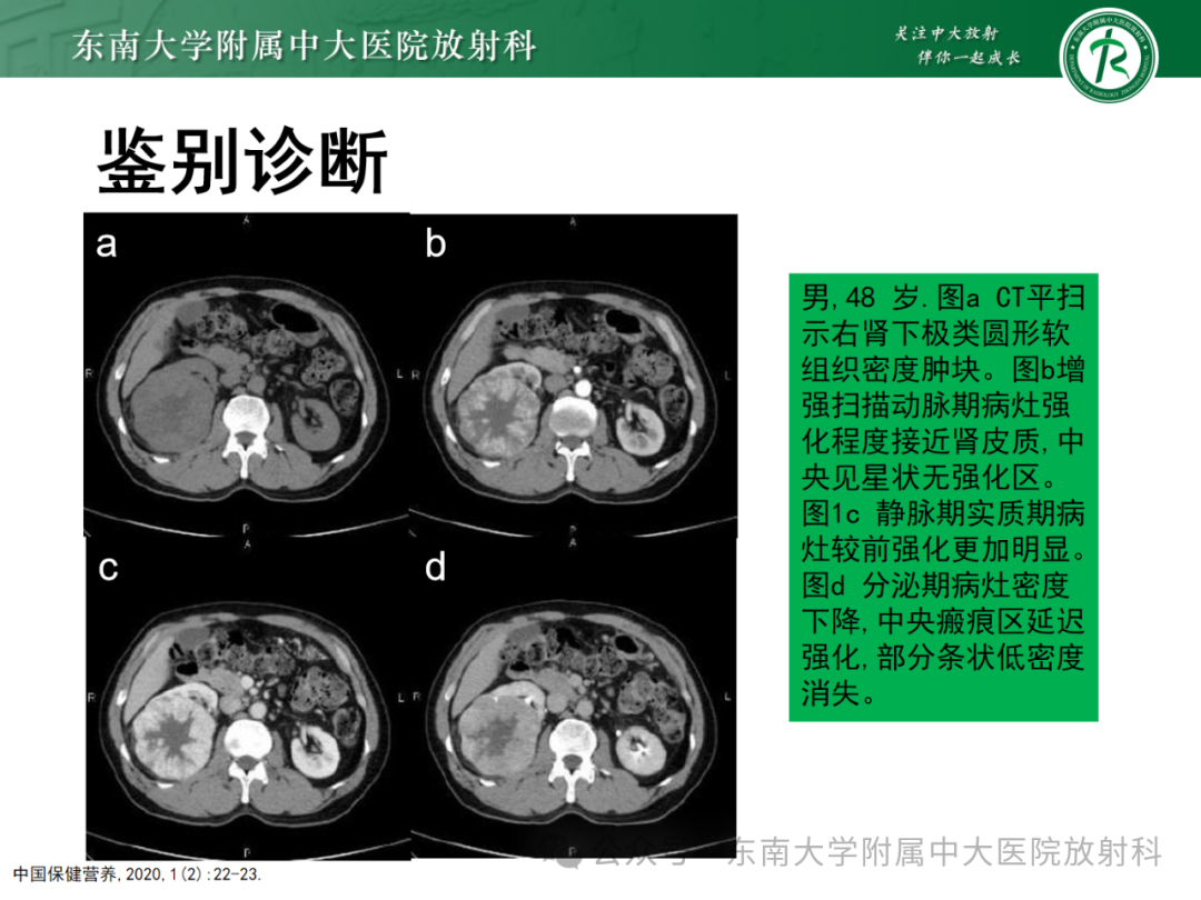 影像PPT - 【PPT】肾嫌色细胞癌-32 影像PPT - 【PPT】肾嫌色细胞癌-32