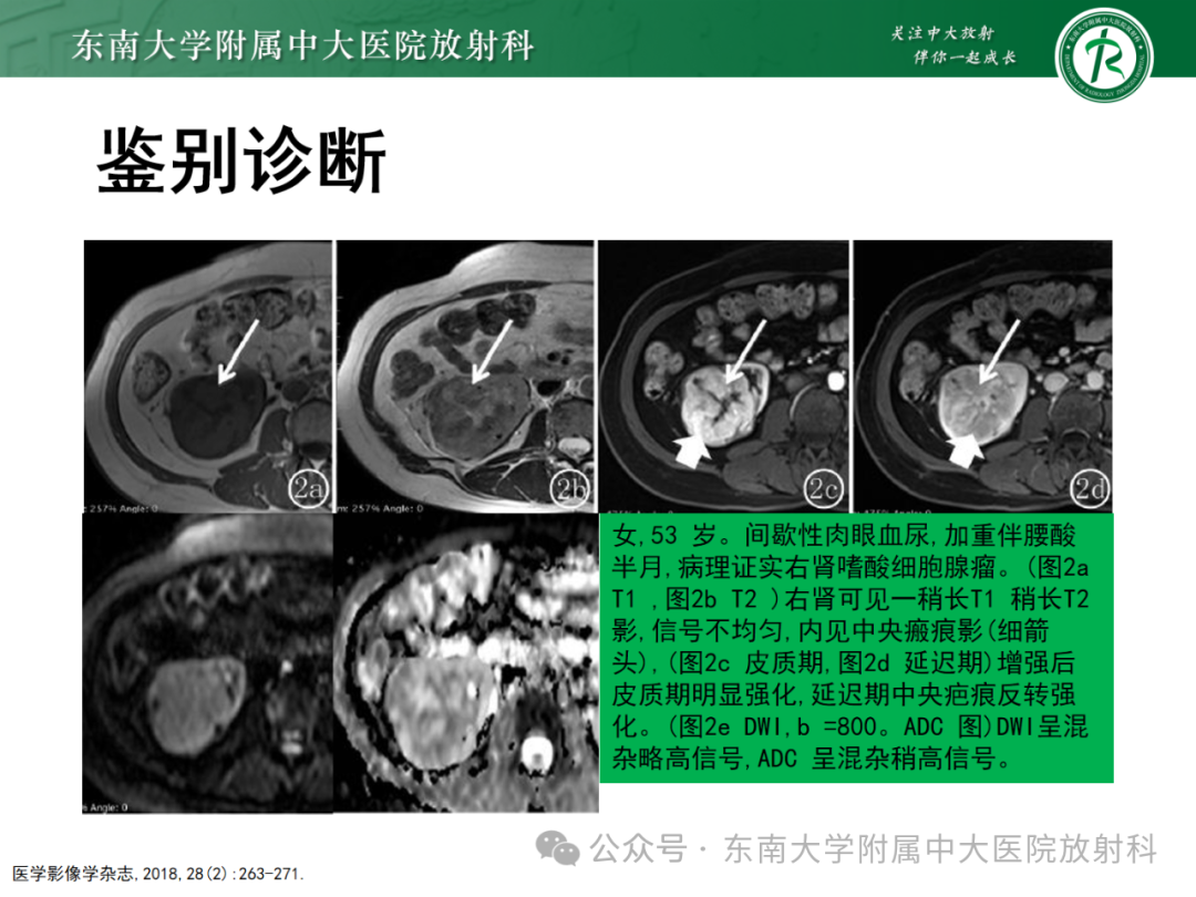 影像PPT - 【PPT】肾嫌色细胞癌-33 影像PPT - 【PPT】肾嫌色细胞癌-33