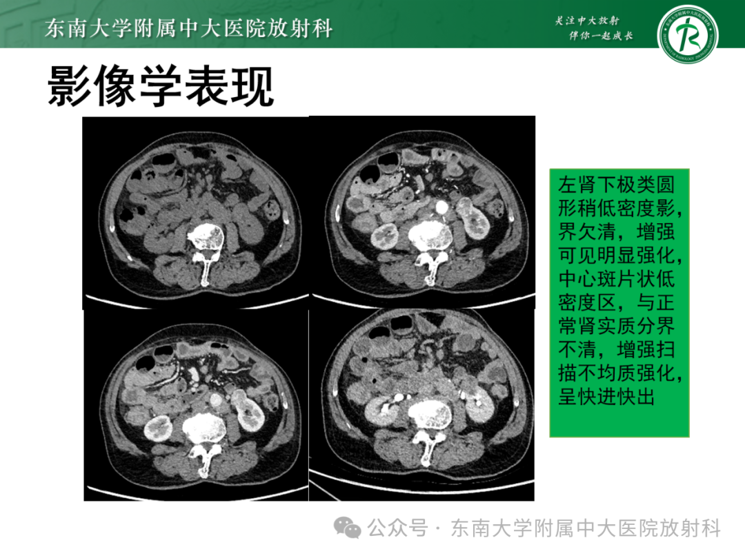 影像PPT - 【PPT】肾嫌色细胞癌-35 影像PPT - 【PPT】肾嫌色细胞癌-35