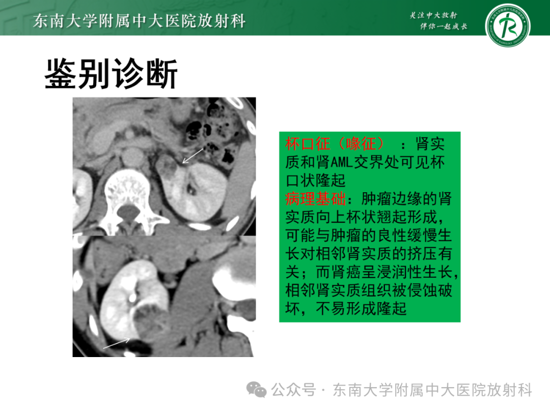 影像PPT - 【PPT】肾嫌色细胞癌-39 影像PPT - 【PPT】肾嫌色细胞癌-39