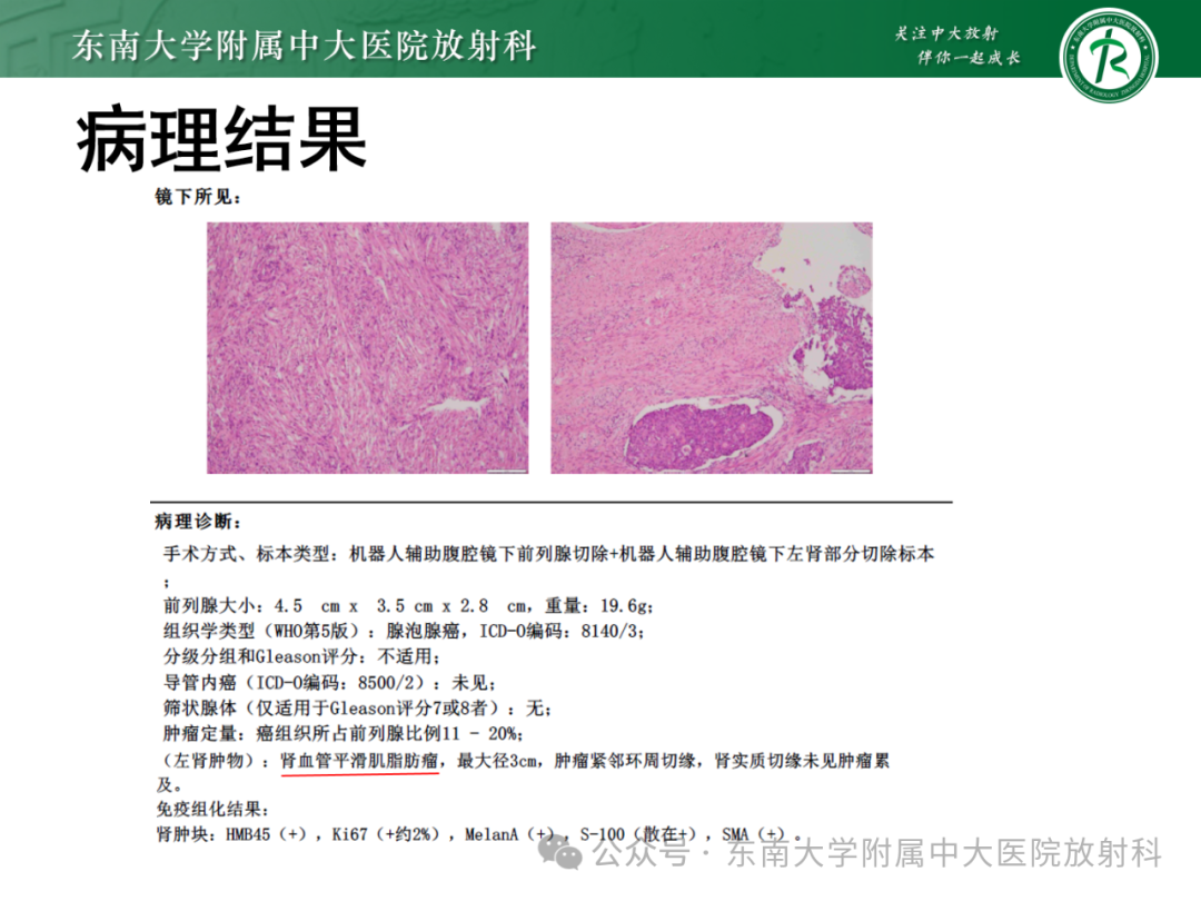 影像PPT - 【PPT】肾嫌色细胞癌-37 影像PPT - 【PPT】肾嫌色细胞癌-37
