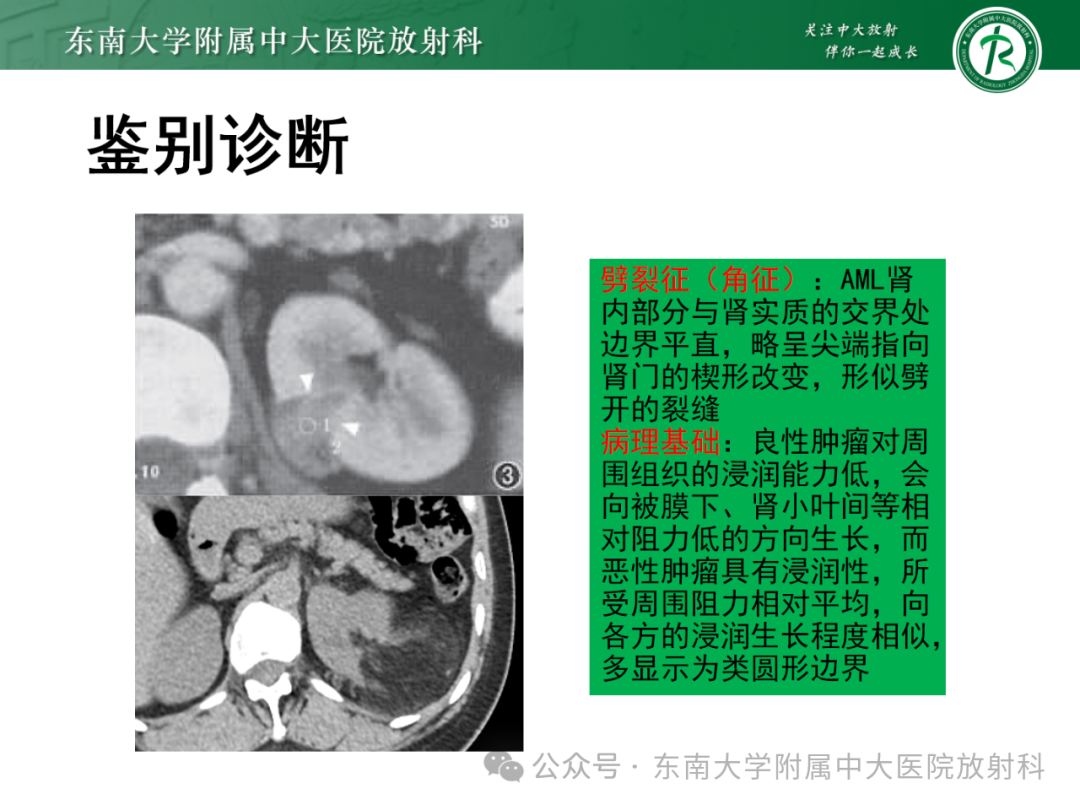 影像PPT - 【PPT】肾嫌色细胞癌-40 影像PPT - 【PPT】肾嫌色细胞癌-40