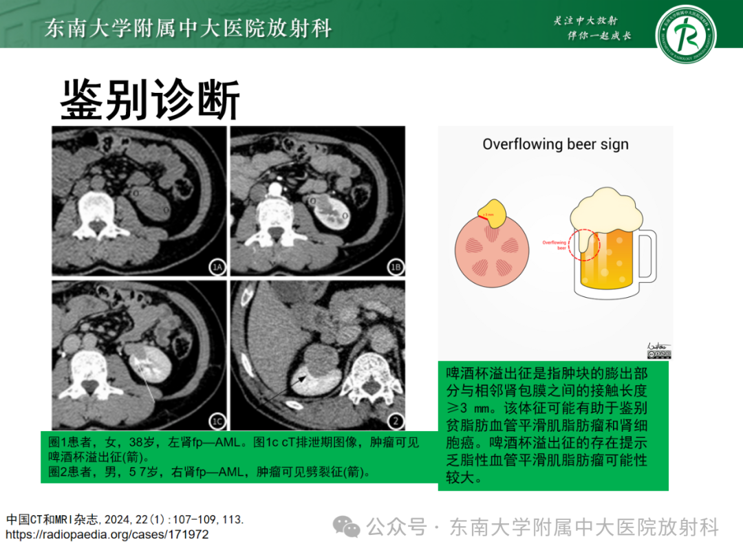 影像PPT - 【PPT】肾嫌色细胞癌-41 影像PPT - 【PPT】肾嫌色细胞癌-41