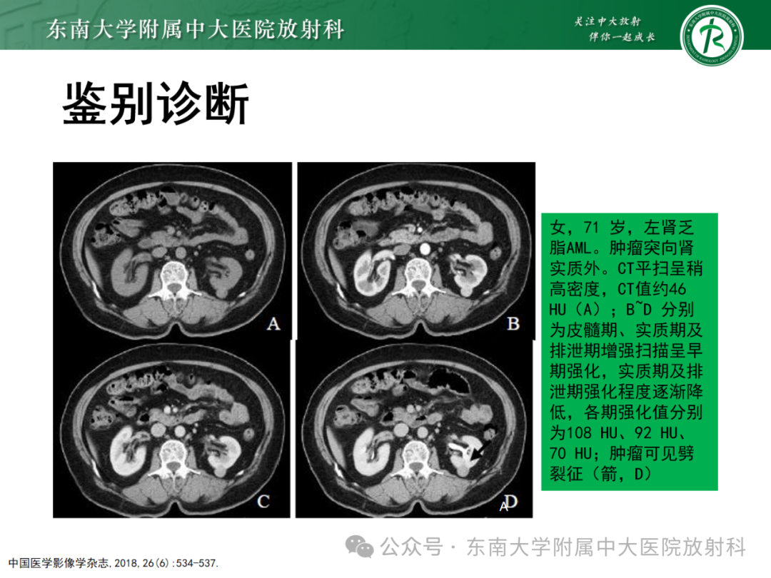 影像PPT - 【PPT】肾嫌色细胞癌-42 影像PPT - 【PPT】肾嫌色细胞癌-42