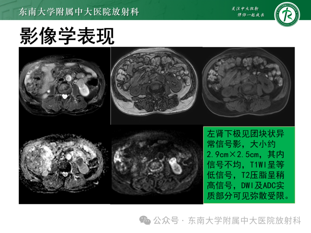 影像PPT - 【PPT】肾嫌色细胞癌-36 影像PPT - 【PPT】肾嫌色细胞癌-36