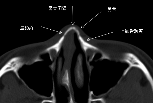 影像PPT - 鼻骨缝的解剖与鼻骨骨折-3 影像PPT - 鼻骨缝的解剖与鼻骨骨折-3
