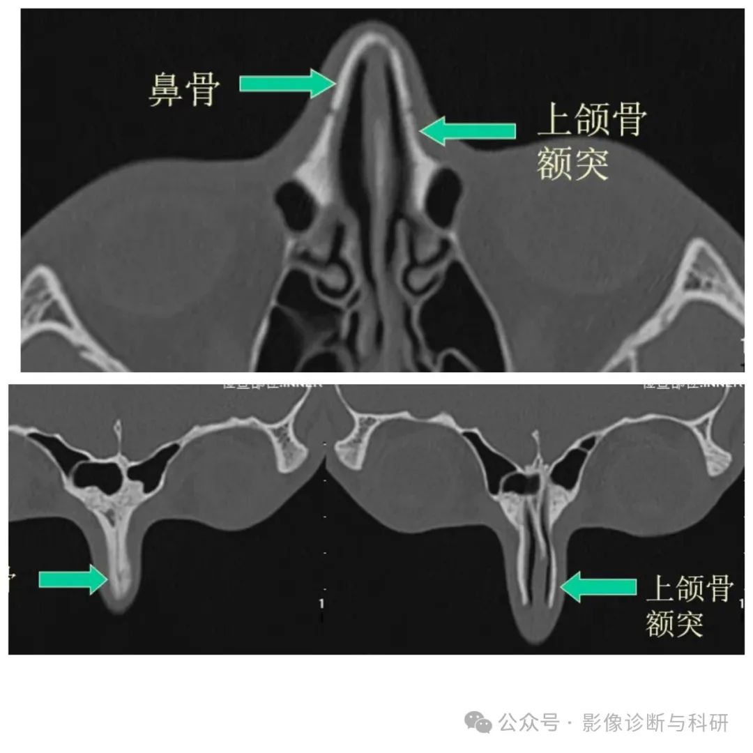 影像PPT - 鼻骨缝的解剖与鼻骨骨折-4 影像PPT - 鼻骨缝的解剖与鼻骨骨折-4
