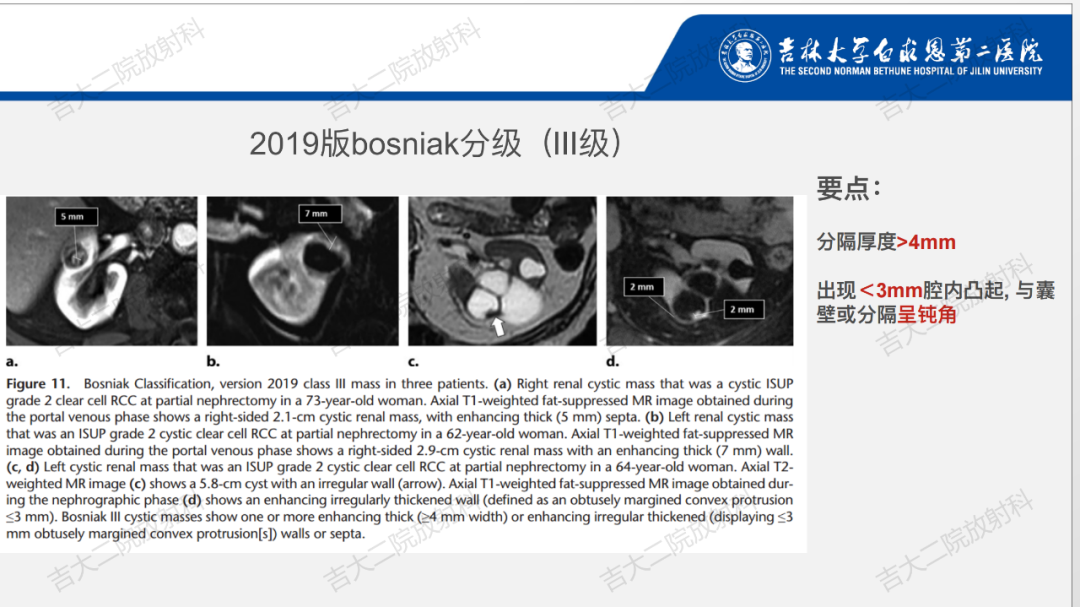 影像PPT - 【PPT】肾脏囊性肿块的Bosniak分级解读（2019版）-19