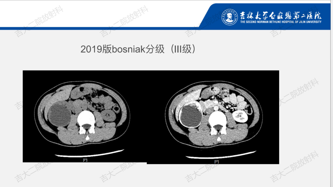 影像PPT - 【PPT】肾脏囊性肿块的Bosniak分级解读（2019版）-20