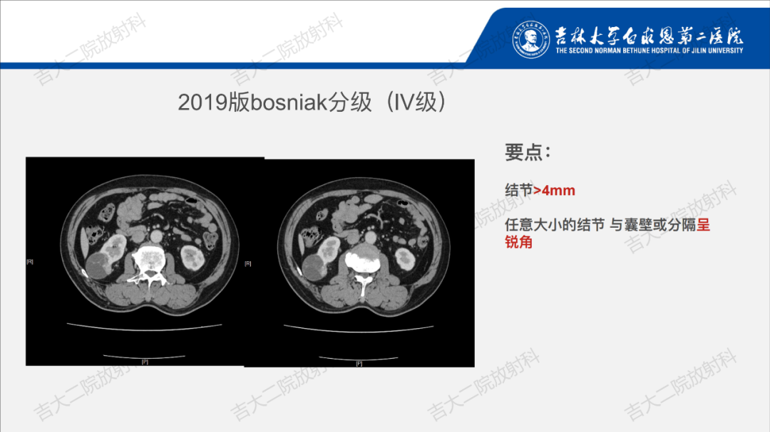 影像PPT - 【PPT】肾脏囊性肿块的Bosniak分级解读（2019版）-21