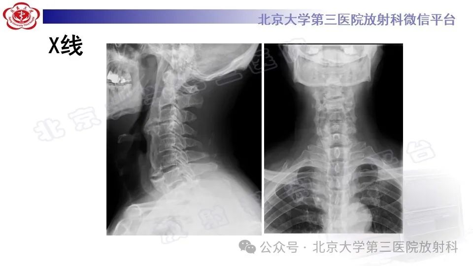 影像PPT - 【PPT】弥漫性特发性骨肥厚症-3