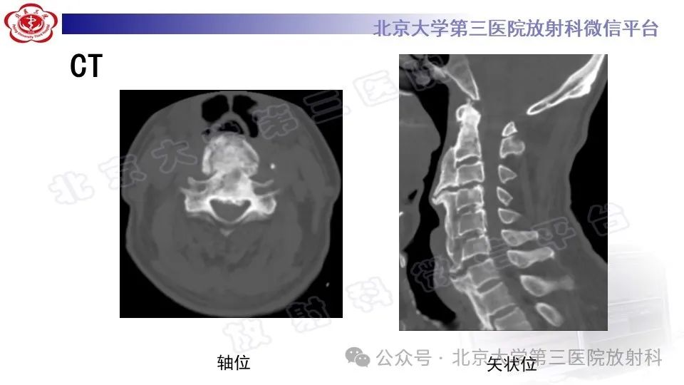 影像PPT - 【PPT】弥漫性特发性骨肥厚症-4