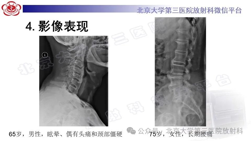 影像PPT - 【PPT】弥漫性特发性骨肥厚症-14
