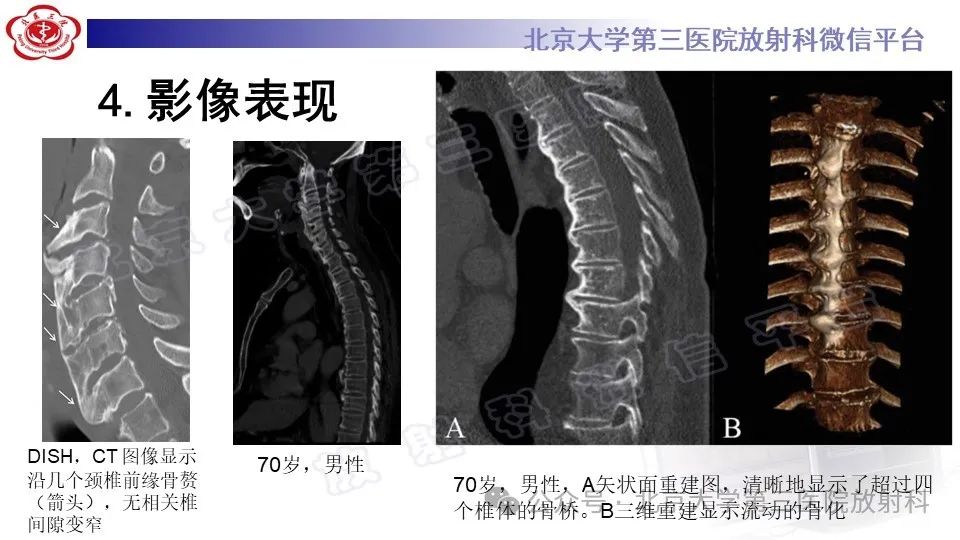 影像PPT - 【PPT】弥漫性特发性骨肥厚症-15