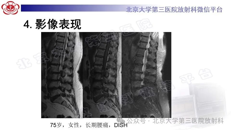 影像PPT - 【PPT】弥漫性特发性骨肥厚症-16