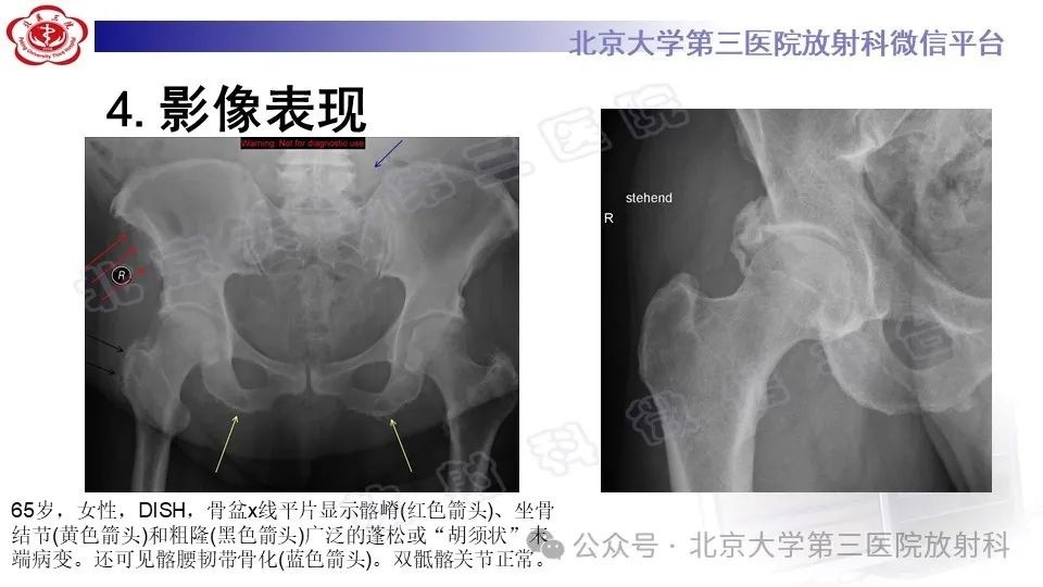 影像PPT - 【PPT】弥漫性特发性骨肥厚症-17