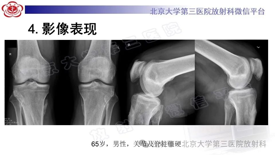 影像PPT - 【PPT】弥漫性特发性骨肥厚症-18
